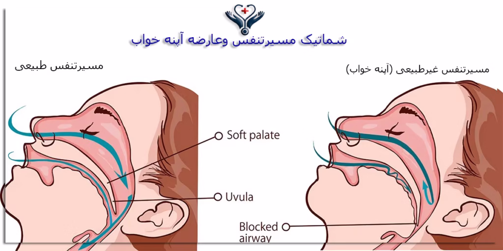 آپنه خواب