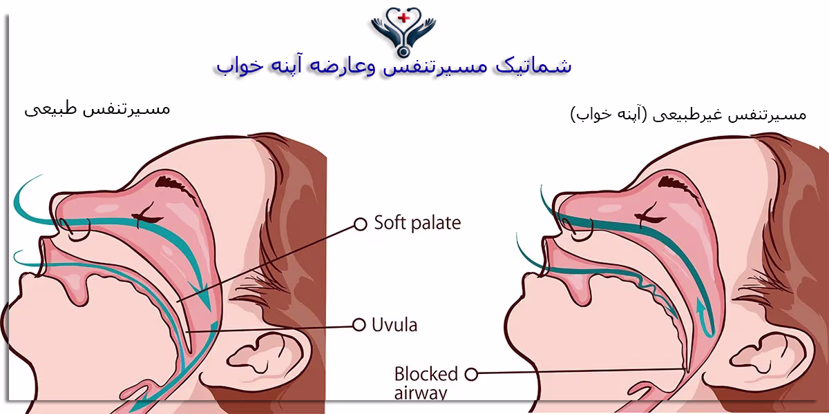 آپنه خواب چیست