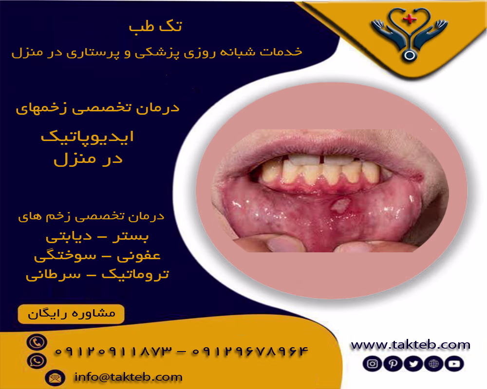 درمان زخم ایدیوپاتیک در منزل تهران