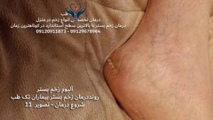 درمان زخم بستردر منزل