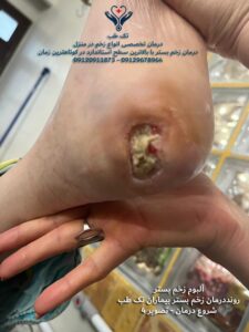 عکس درمان زخم بستر بیماران تک طب