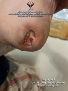 درمان زخم بستر در پاشنه پا