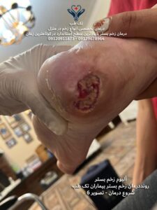درمان زخم بستردر منزل