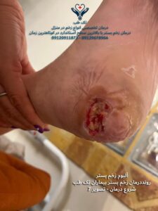 درمان زخم بستردر منزل