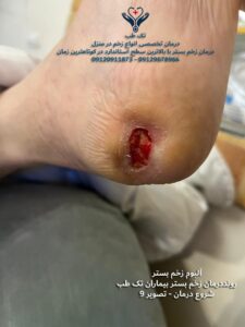 درمان زخم بستردر منزل