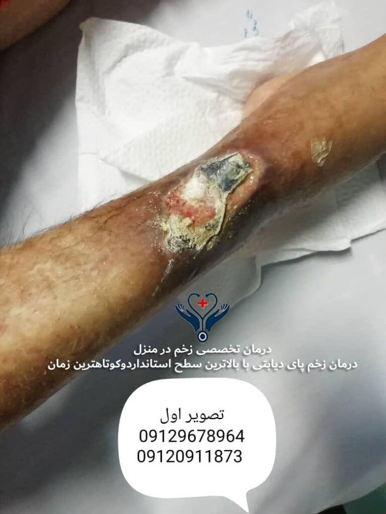 قبل از درمان زخم پای دیابتی - بیمار تحت درمان در منزل جنوب تهران تک طب