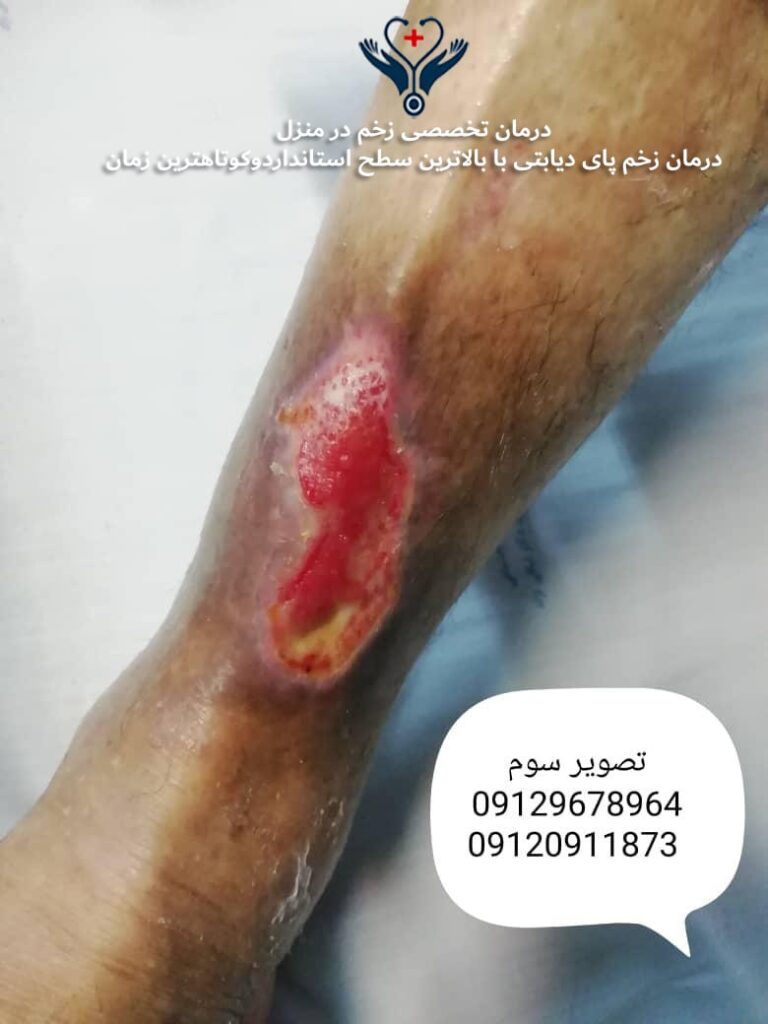 روند بهبود زخم پای دیابتی در منزل - خدمات تک طب