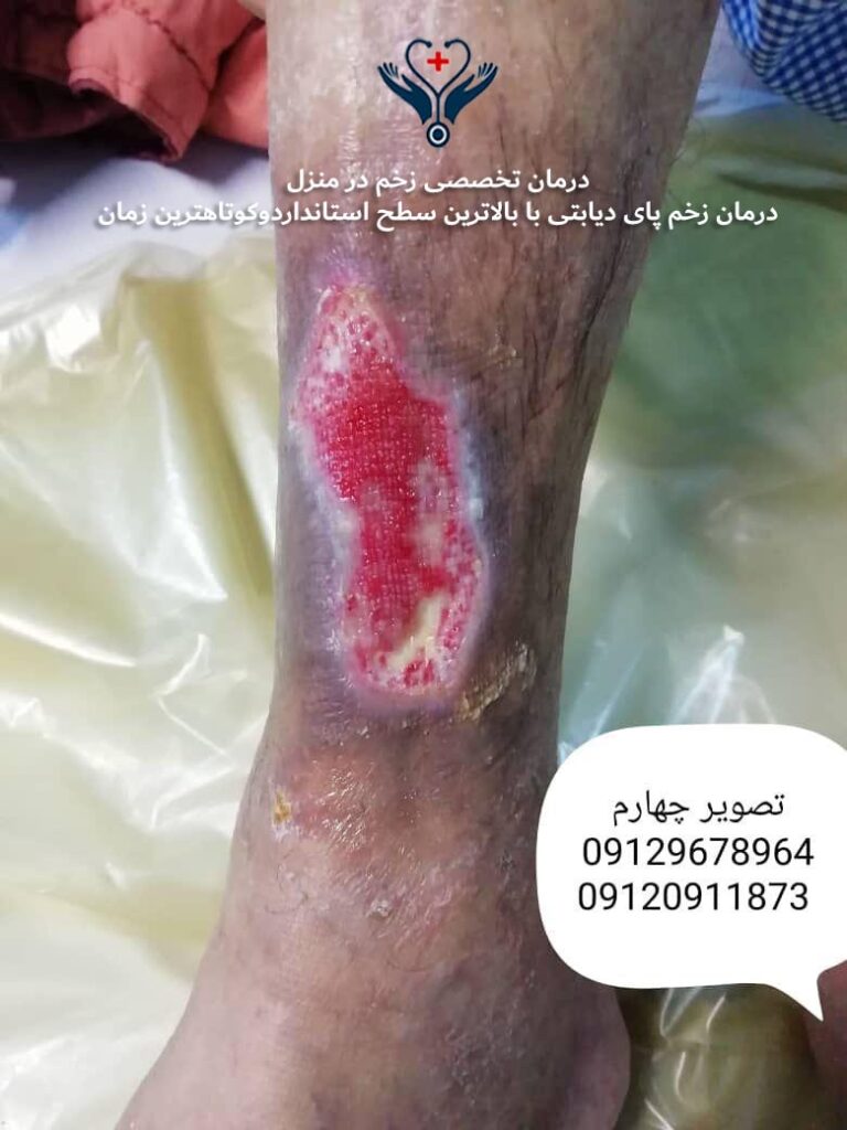 پیشرفت درمان زخم پای دیابتی با بهترین روش‌ها در منزل جنوب تهران