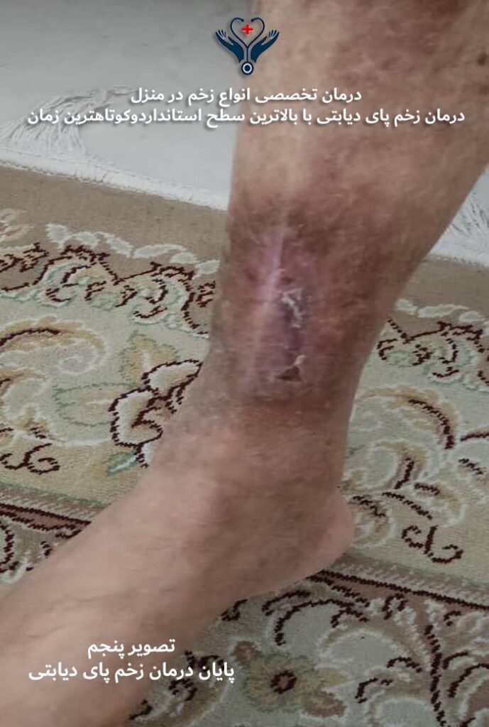 بعد از درمان زخم پای دیابتی در منزل - نتایج موفق تک طب جنوب تهران