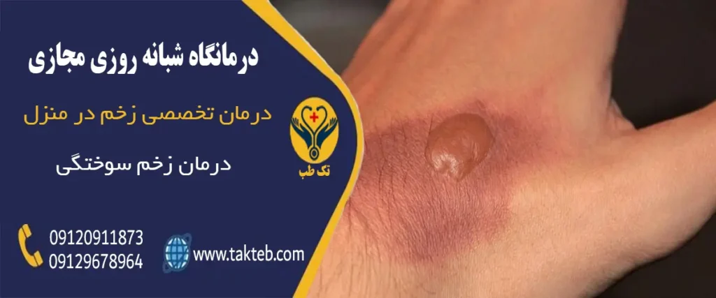درمان زخم سوختگی در منزل تهران تک طب