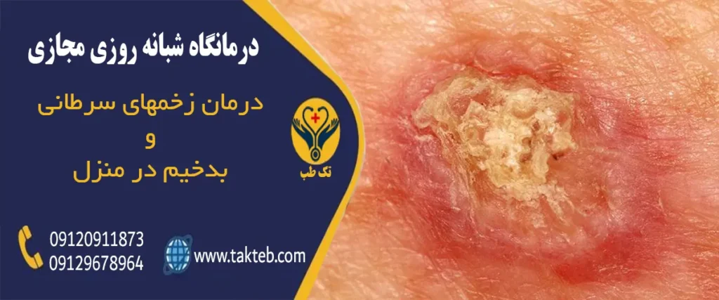 درمان زخم سرطانی در منزل