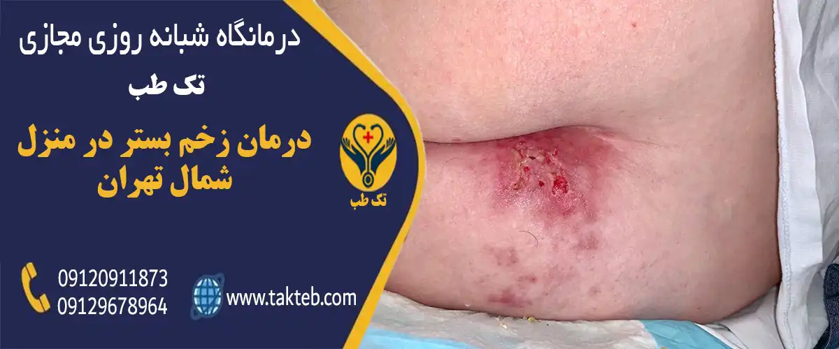 درمان زخم بستر در منزل شمال تهران توسط پرستاران متخصص مرکز درمانی تک طب