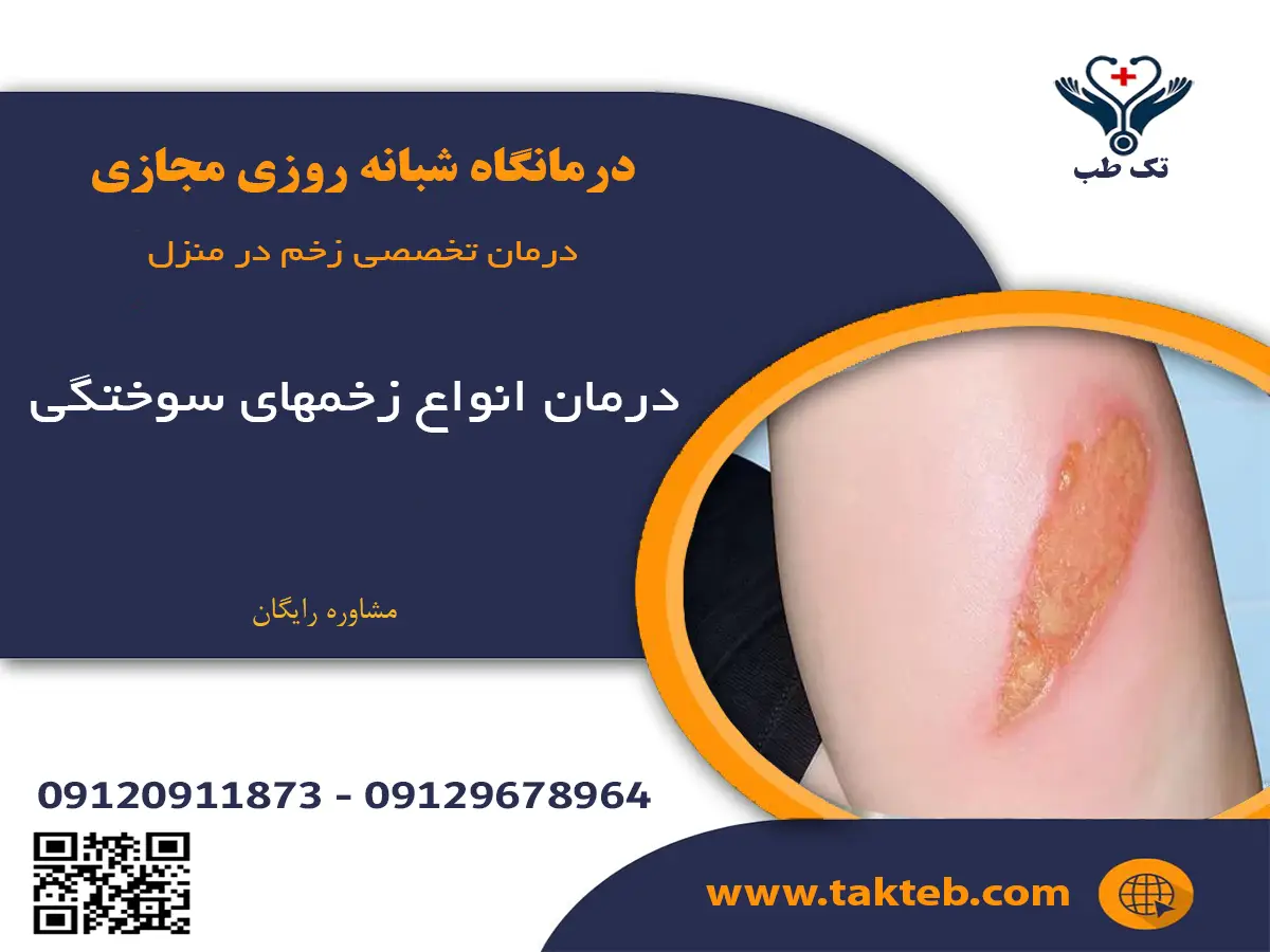 درمان زخم سوختگی در منزل توسط بهترین کارشناس زخم تهران